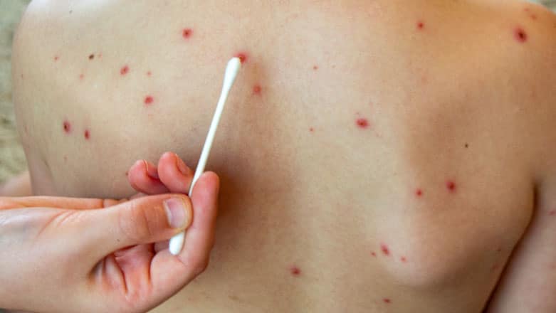 Epidemie de rujeola | INSP: 445 de cazuri noi confirmate